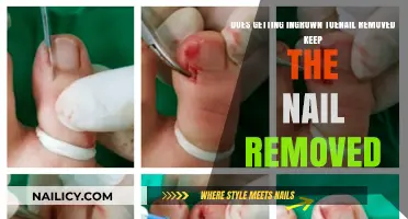 Ingrown Toenail Removal: Does It Keep the Nail from Growing Back?