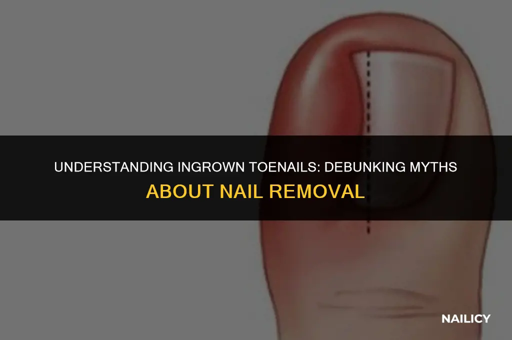 does getting the botdet of the nail removed uirt