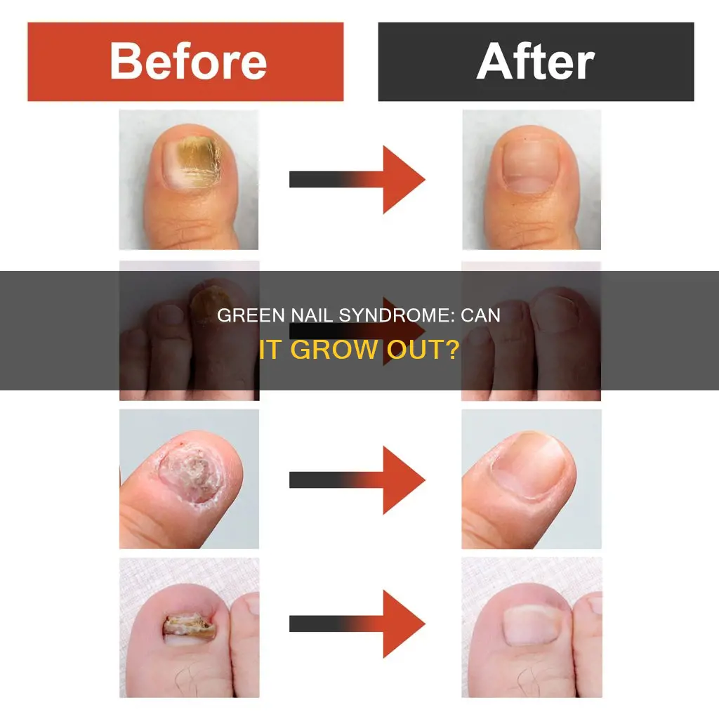 does green nail syndrome grow out