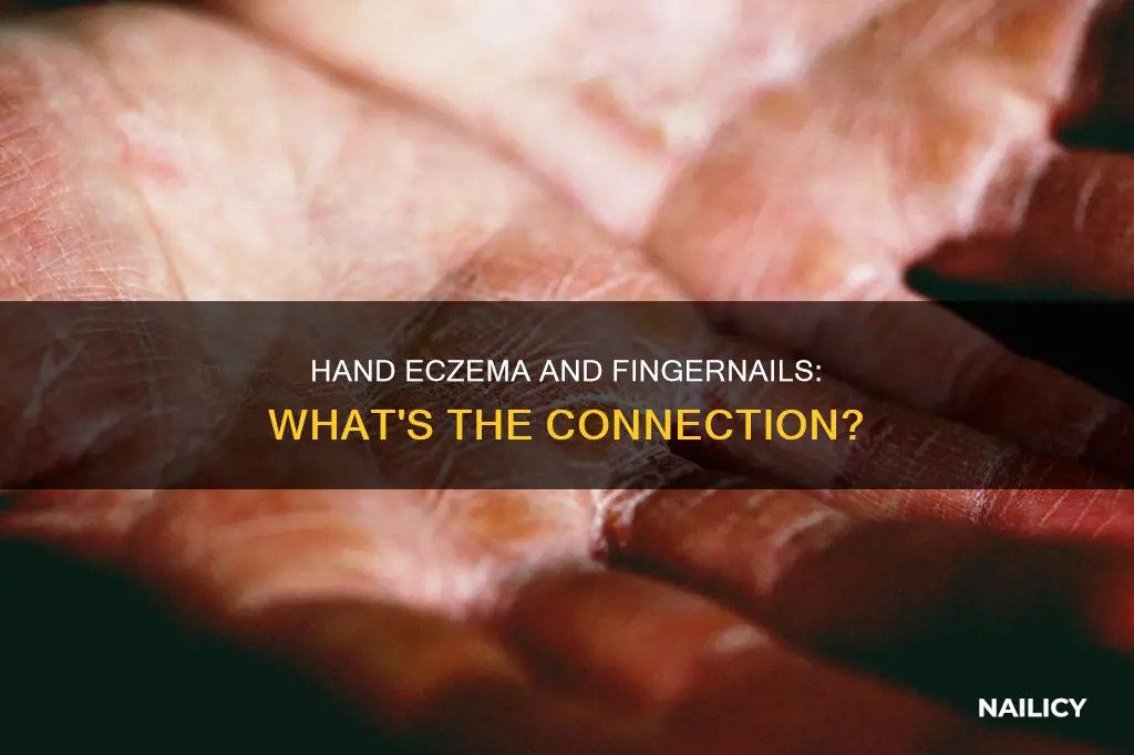 does hand eczema cause a lose of finger nail