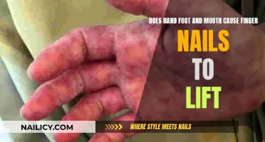 Hand, Foot, and Mouth: Nails at Risk?