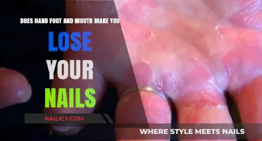 Hand, Foot, and Mouth Disease: Nail Loss Explained and Prevented