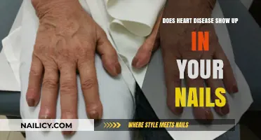 Can Your Nails Reveal Hidden Signs of Heart Disease?
