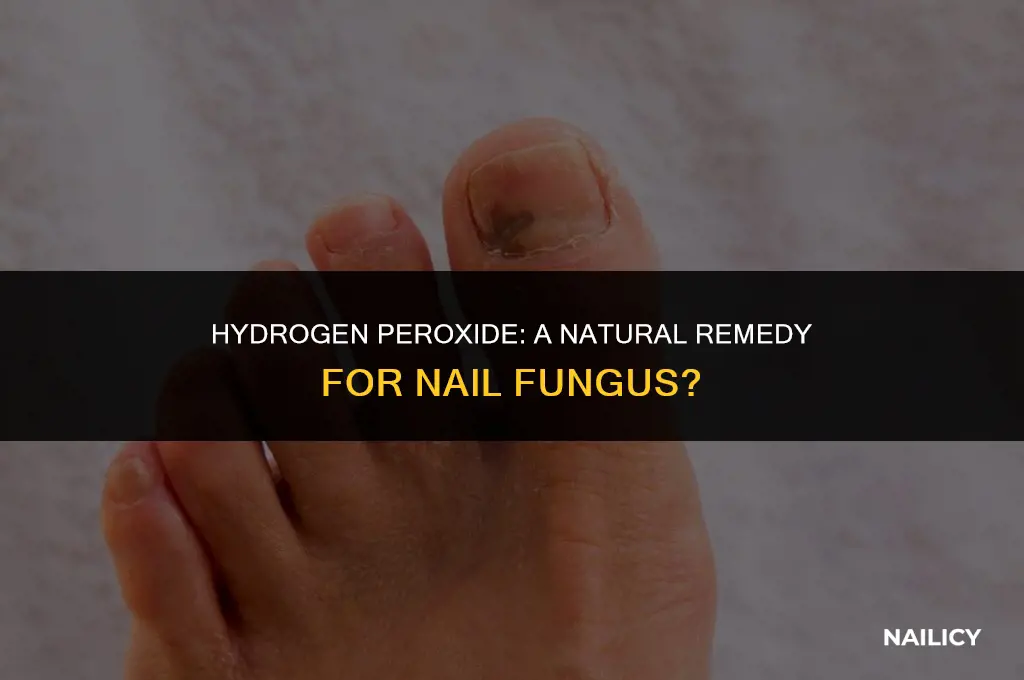 does hydrogen peroxide get rid of nail fungus