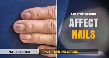 Hyperthyroidism and Nail Health: Uncovering the Surprising Connection
