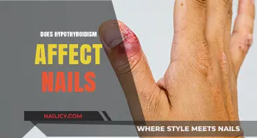 Hypothyroidism and Nail Health: Uncovering the Surprising Connection