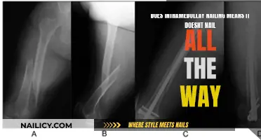 Intramedullary Nailing: Partial Fixation, Complete Healing