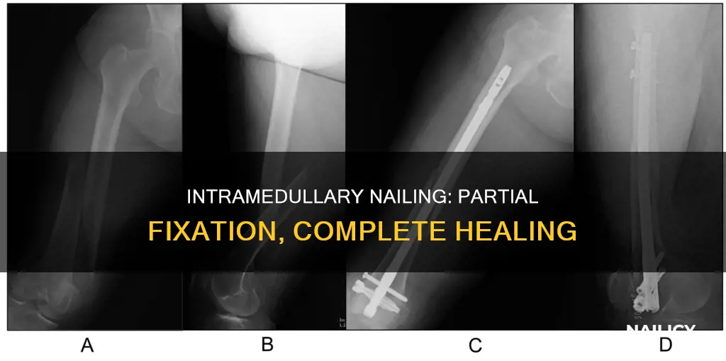 does intramedullay nailing means it doesnt nail all the way