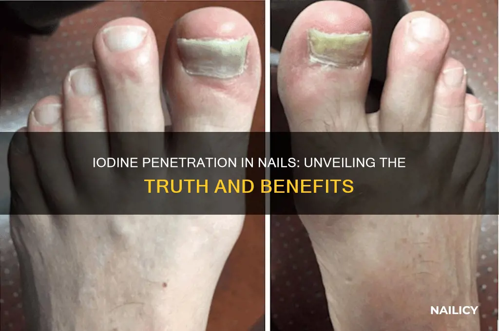 does iodine penetrate nails