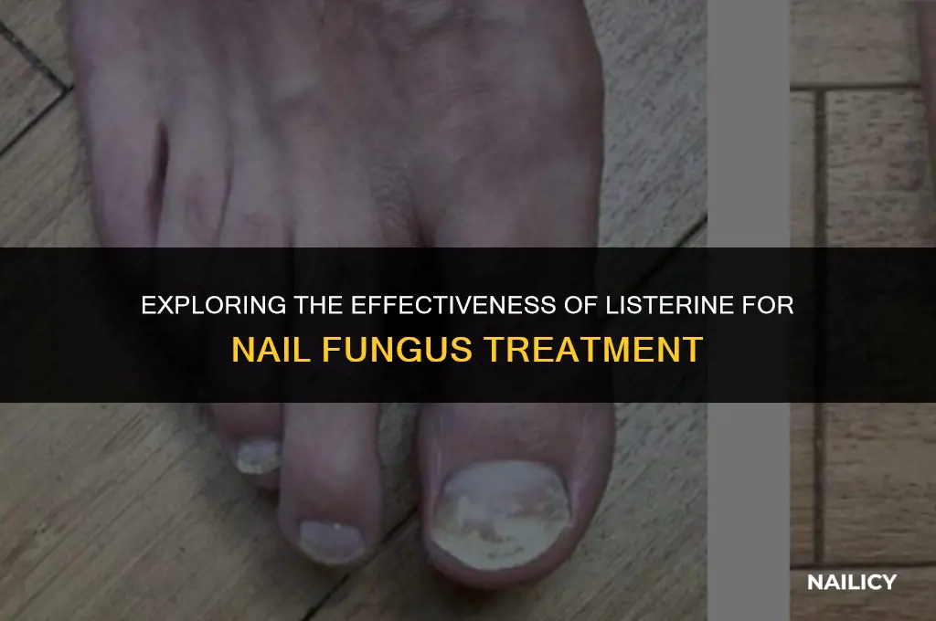 does it work to use listerine for nail fungus