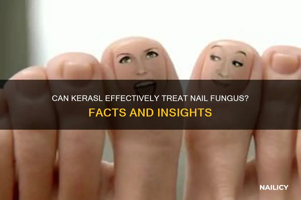 does kerasl cure nail fubgus