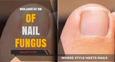 Laser Treatment for Nail Fungus: Does It Really Work?