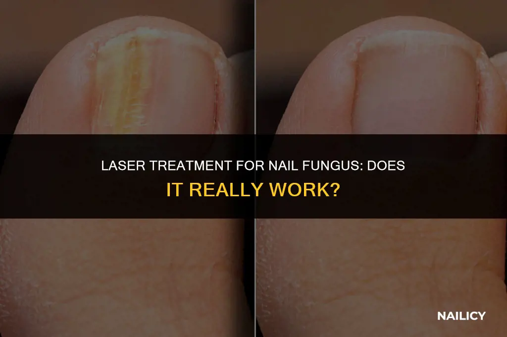 does laser get rid of nail fungus