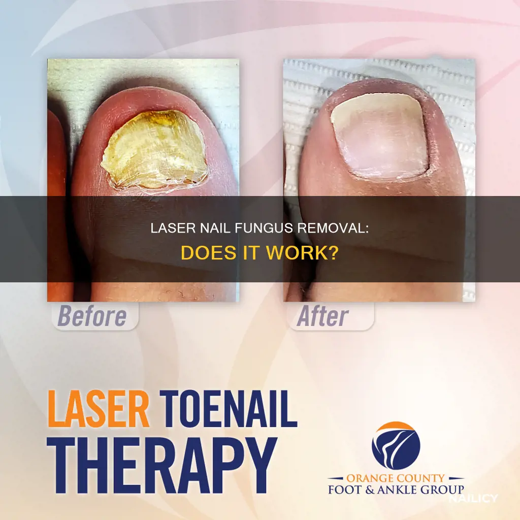 does laser nail fungus removal work