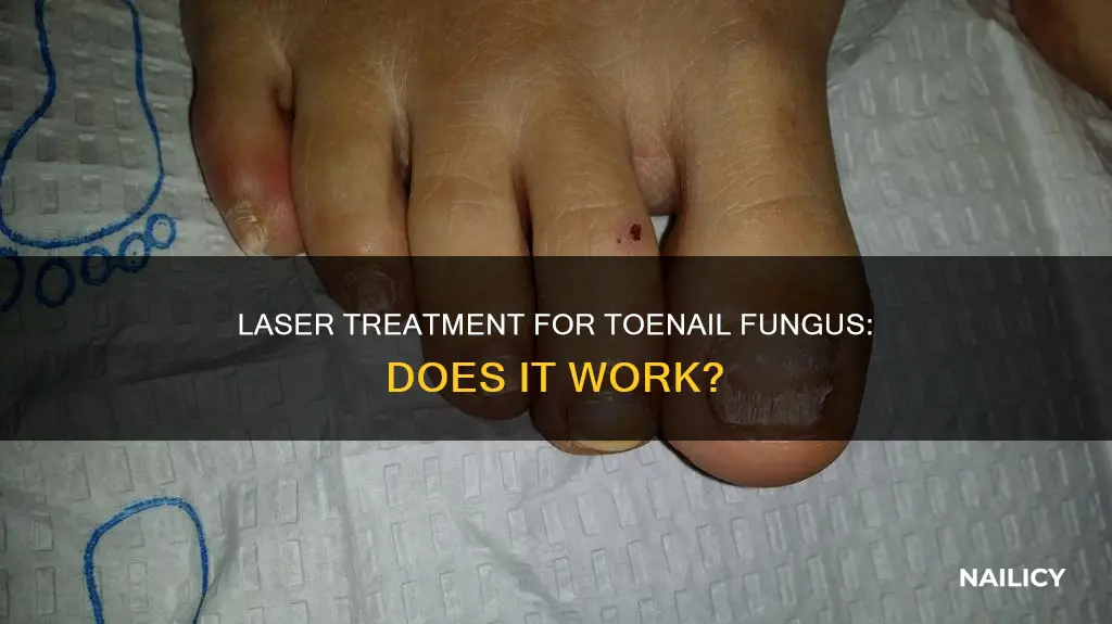 does laser toe nail fungus removal work
