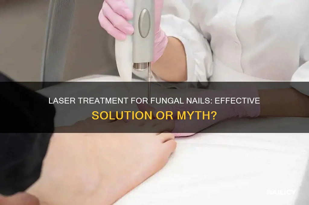 does laser treatment for fungal nail work