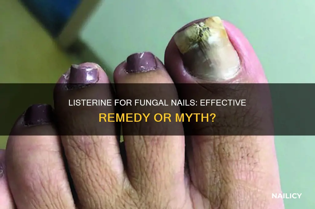 does listerine help fungal nails