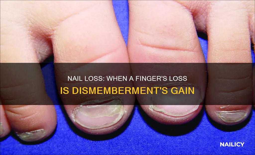 does losing a nail finger considered dismemberment