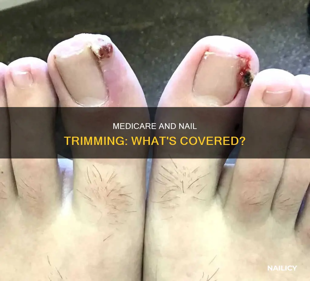 does medicare cover nail trimming