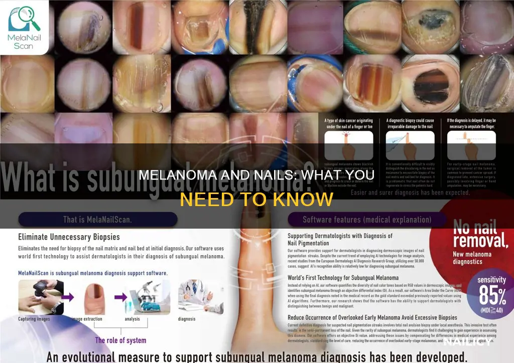 does melanoma grow out with the nail