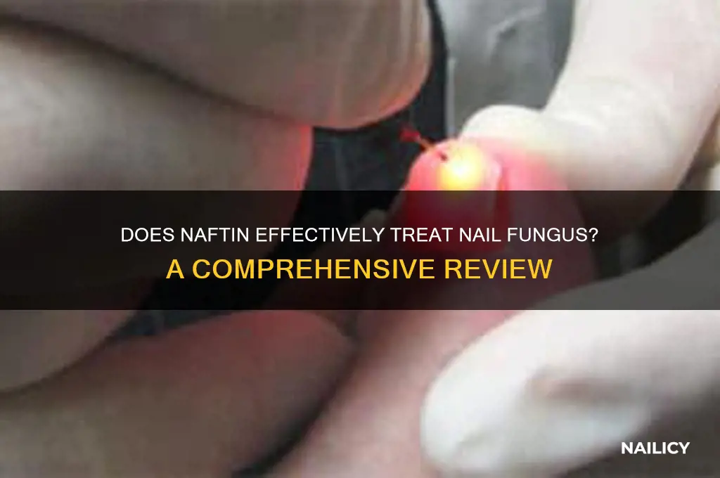 does naftin work on the nail itself