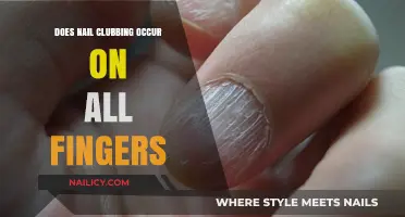 Does Nail Clubbing Affect All Fingers? Understanding Its Distribution