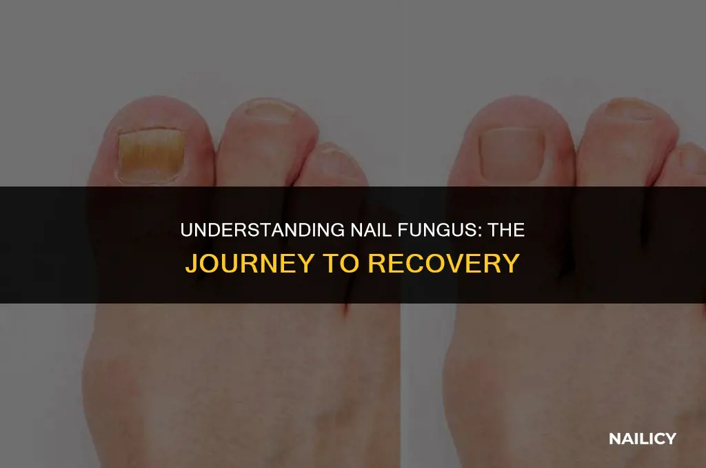 does nail fungus get worse before it gets better