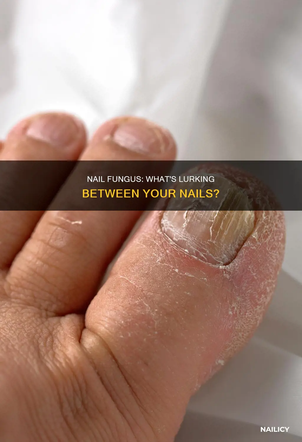 does nail fungus grow between the nail