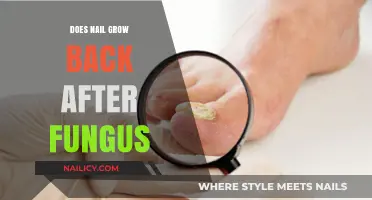 Nail Fungus: Will Nails Grow Back?