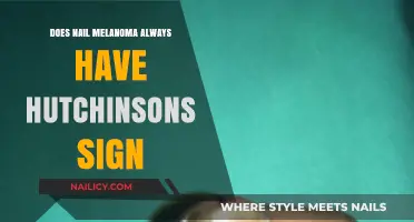 Nail Melanoma and Hutchinson's Sign: Is It Always Present?