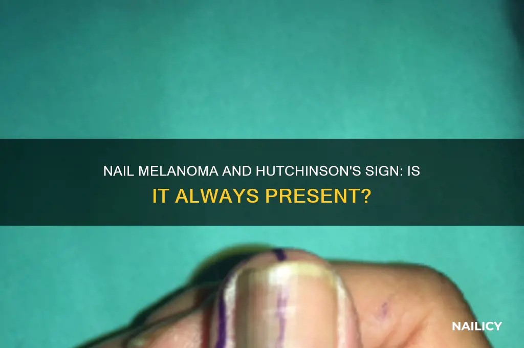 does nail melanoma always have hutchinsons sign