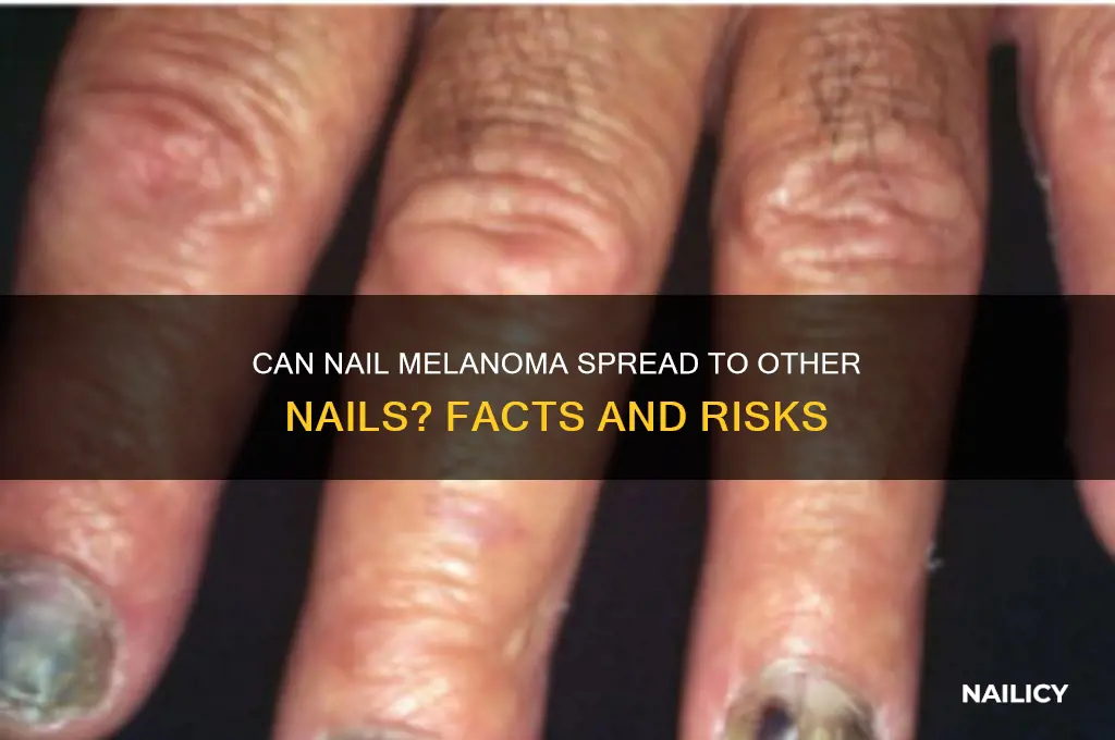 does nail melanoma spread to other nails