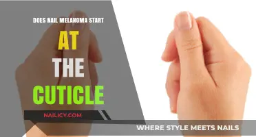 Nail Melanoma: Does It Begin at the Cuticle? Uncovering Facts