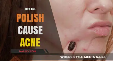 Nail Polish and Acne: Uncovering the Surprising Skin Connection