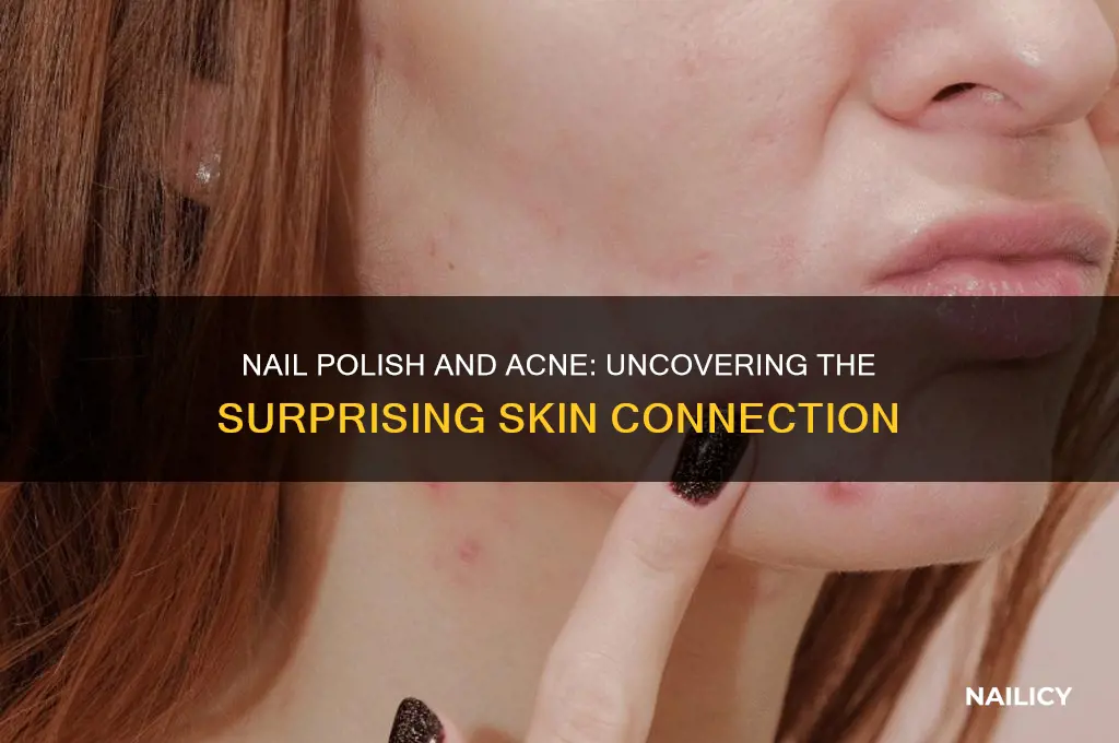 does nail polish cause acne