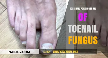 Toenail Fungus: Can Nail Polish Be a Solution?
