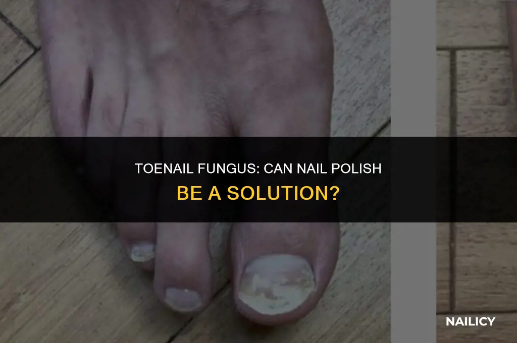 does nail polish get rid of toenail fungus