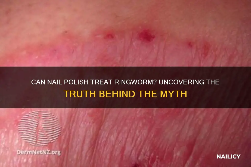 does nail polish help ringworm