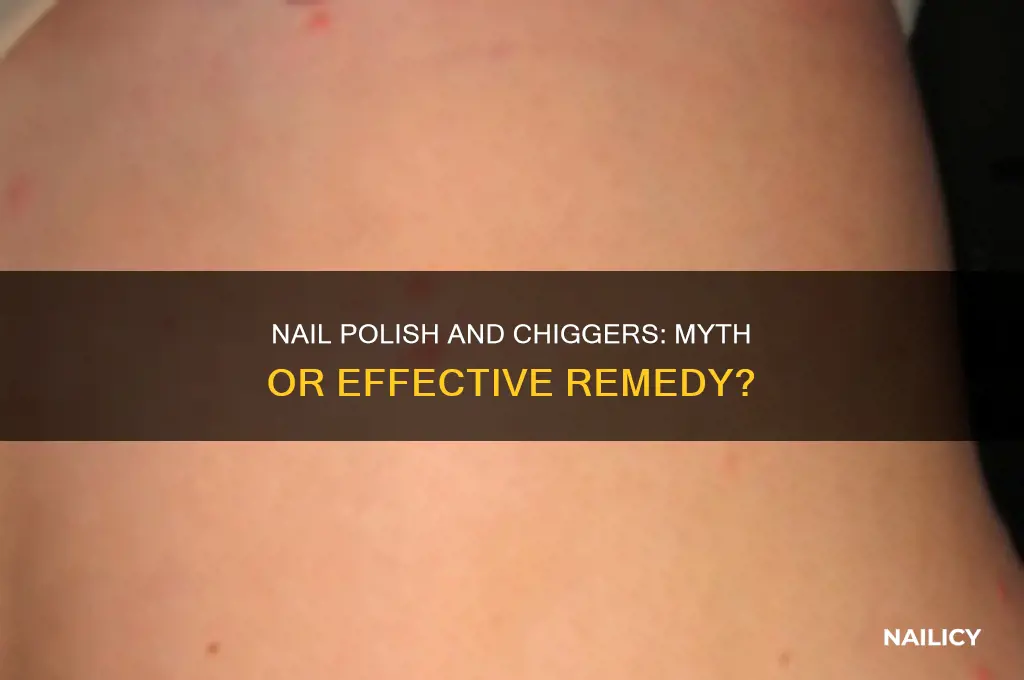does nail polish kill chiggers
