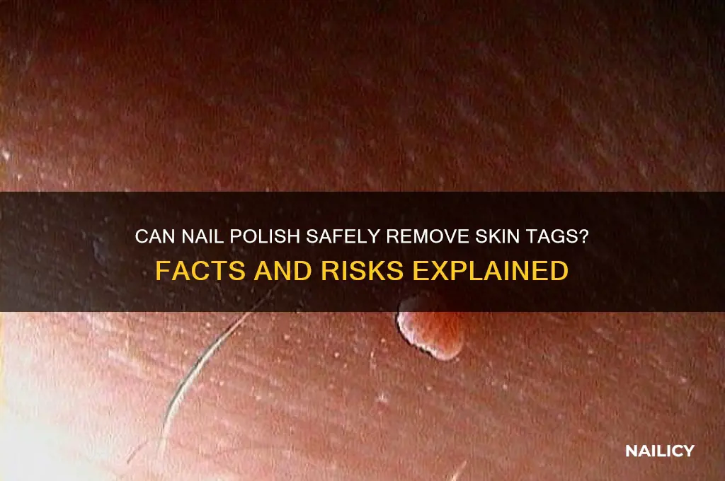 does nail polish kill skin tags