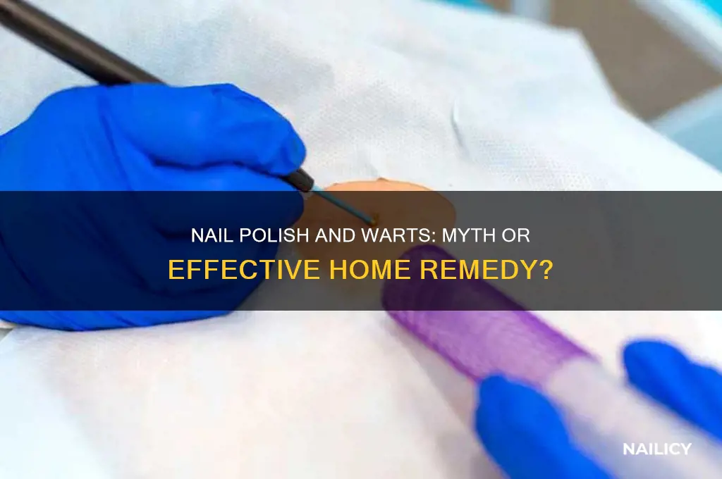 does nail polish kill warts