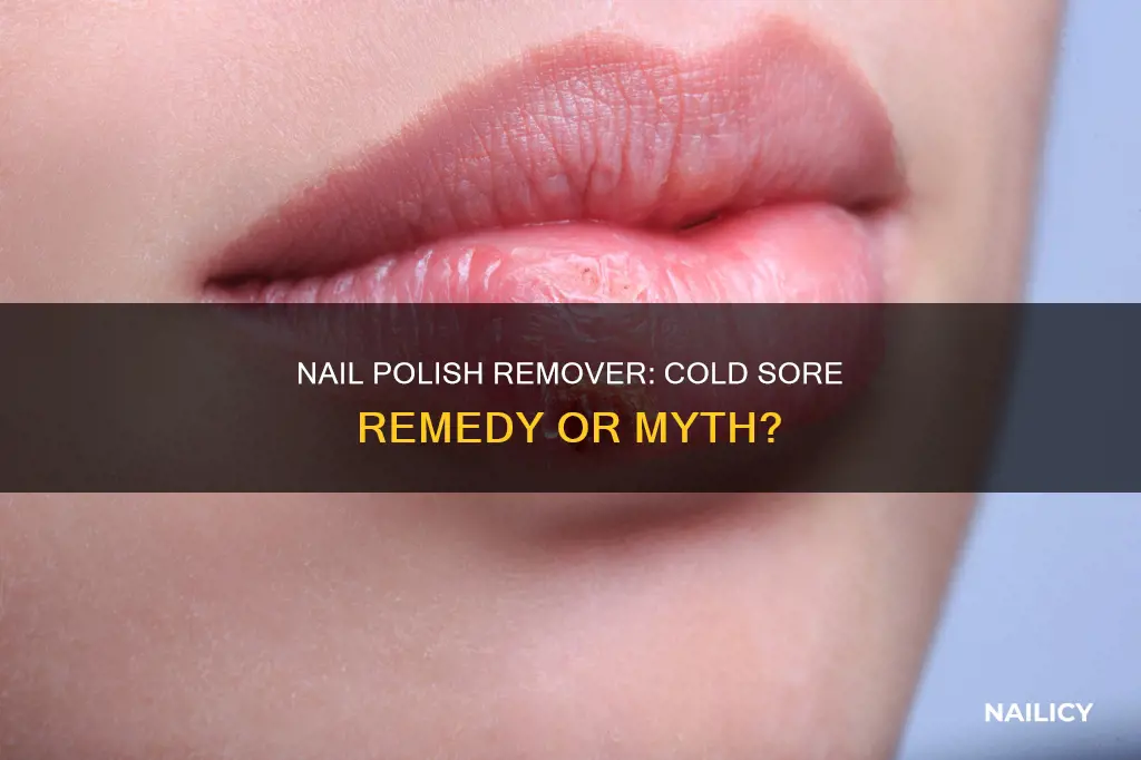 does nail polish remover cure cold sores