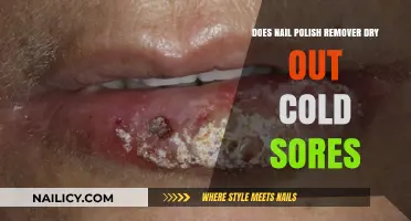 Nail Polish Remover: Cold Sore Treatment or Trigger?
