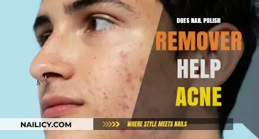 Nail Polish Remover: Acne Treatment or Skin Disaster?