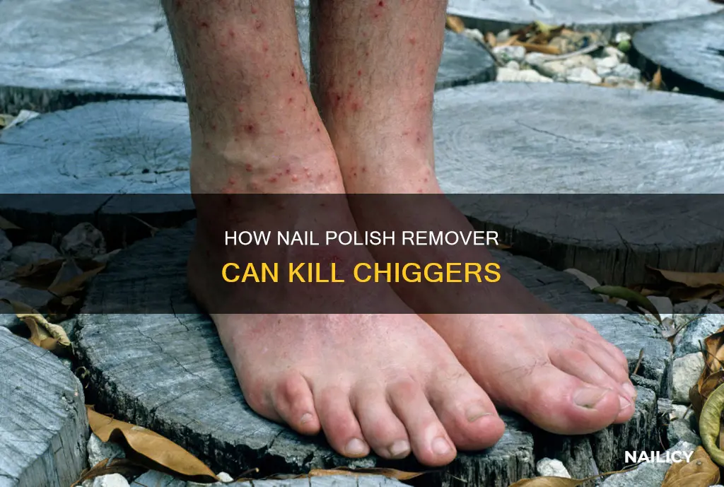 does nail polish remover kill chiggers