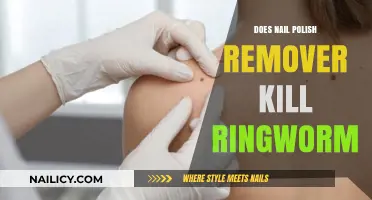 Nail Polish Remover: A Ringworm Treatment?