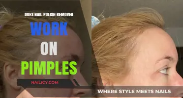 Can Nail Polish Remover Zap Pimples?
