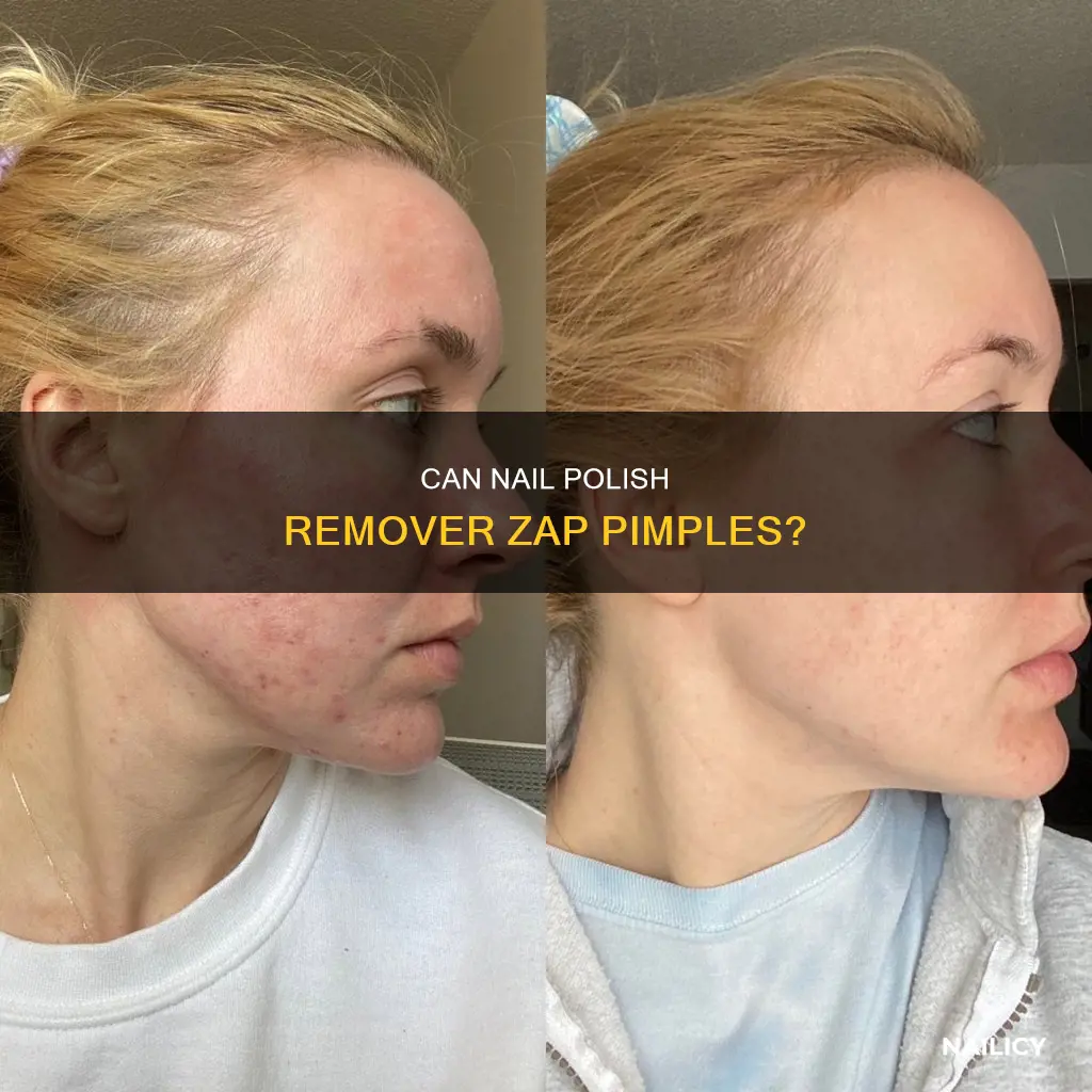 does nail polish remover work on pimples