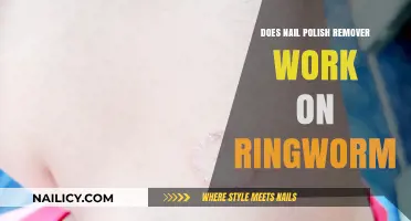 Nail Polish Remover: Effective Against Ringworm?