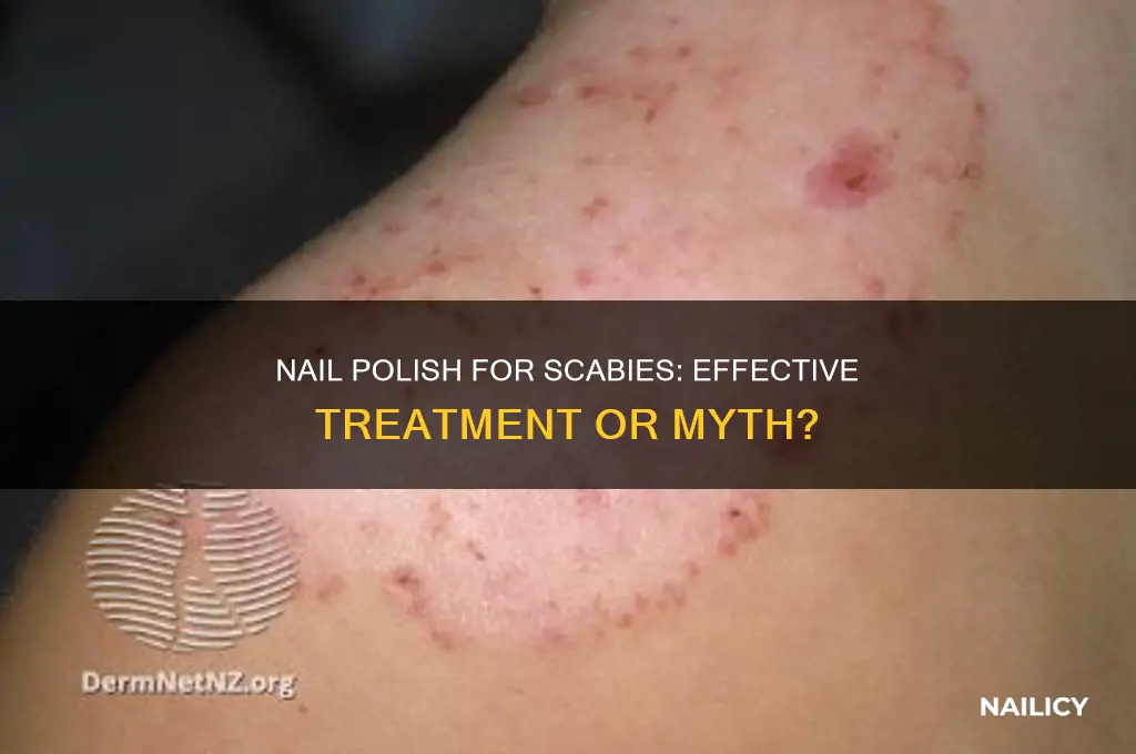 does nail polish work for scabies